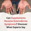 can-supplements-reverse-scleroderma-symptoms.jpg
