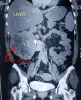 ct-large-kidney-cancer-01-826x1024.jpg