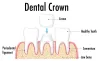 dental_crowns_narangba.jpg