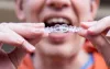 invisalign-red-bank-1080x675.jpg