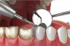 teeth_cleaning_penrith8.png