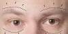 upper-vs-lower-eyelid-surgery.jpg